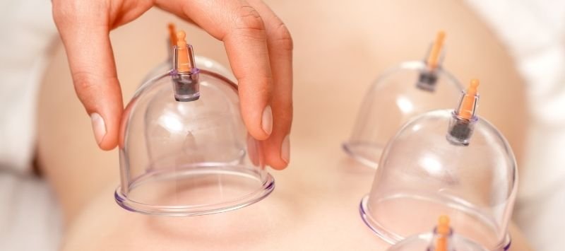 Aplicación de ventosas terapéuticas en la espalda